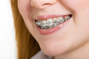 Büyüme ve Gelişim Döneminde Olanlarda Ortodonti